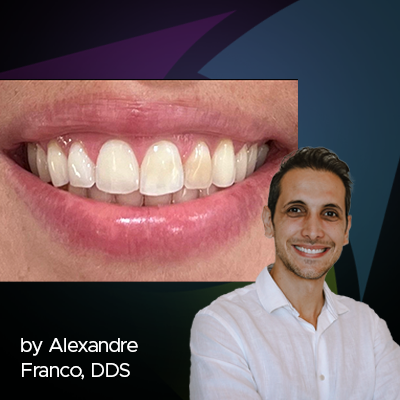 L’importance d’un diagnostic correct pour un traitement de blanchiment des dents correct (et efficace) 