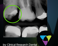 tooth x-ray with green circle