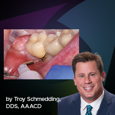 Utilizing a Soft Tissue Diode Laser for a Direct Resin Restoration