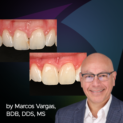 clinical image after the diastema closure procedure