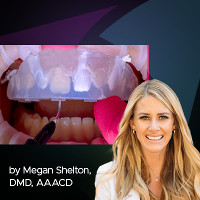 Using Injection Molding Composite Veneers as a Transitional Guide During Orthodontic Treatment