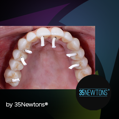 Thumbnail image for blog post showing teeth with white screws in it