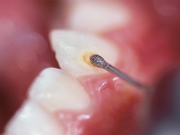 Chargez l&#39;image dans la visionneuse de la galerie, 830M micro preparation diamond bur during cavity preparation
