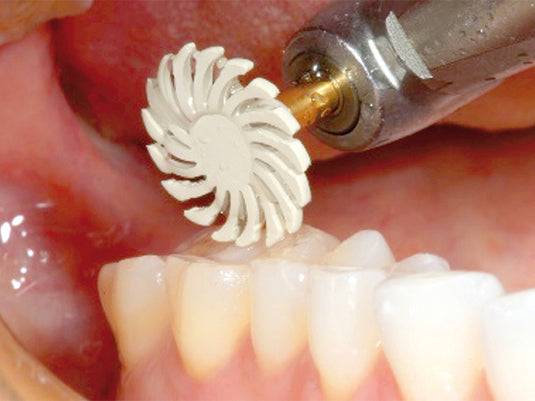 94028F composite polisher wheel in a patient mouth while polishing composite