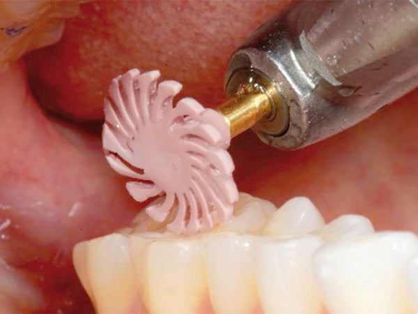 Chargez l&#39;image dans la visionneuse de la galerie, 94028M composite pre-polisher wheel in a patient mouth while polishing composite
