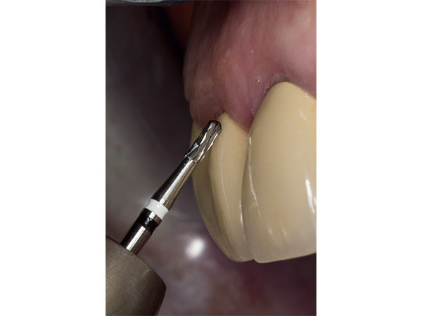 Chargez l&#39;image dans la visionneuse de la galerie, H4MCL crown cutter in a patient mouth at an angle of 45 degrees
