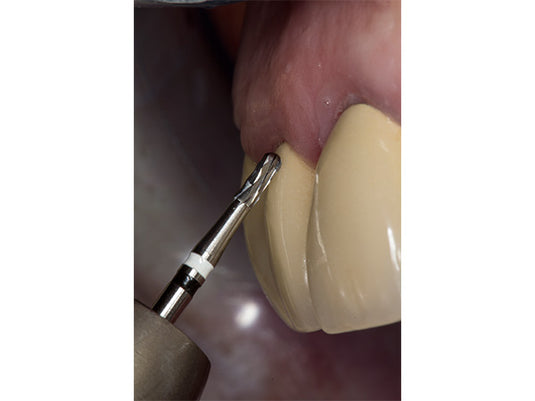 H4MCL crown cutter in a patient mouth at an angle of 45 degrees